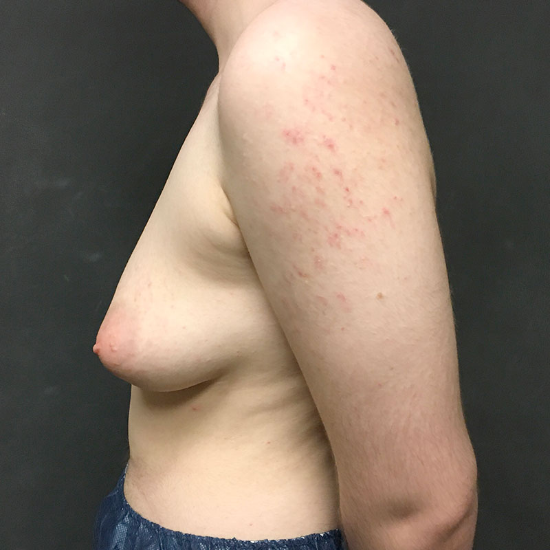 Female To Male Top Surgery 05