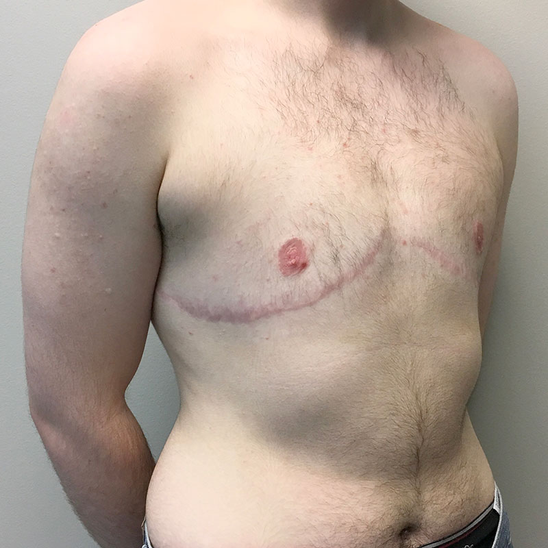 Female To Male Top Surgery 07