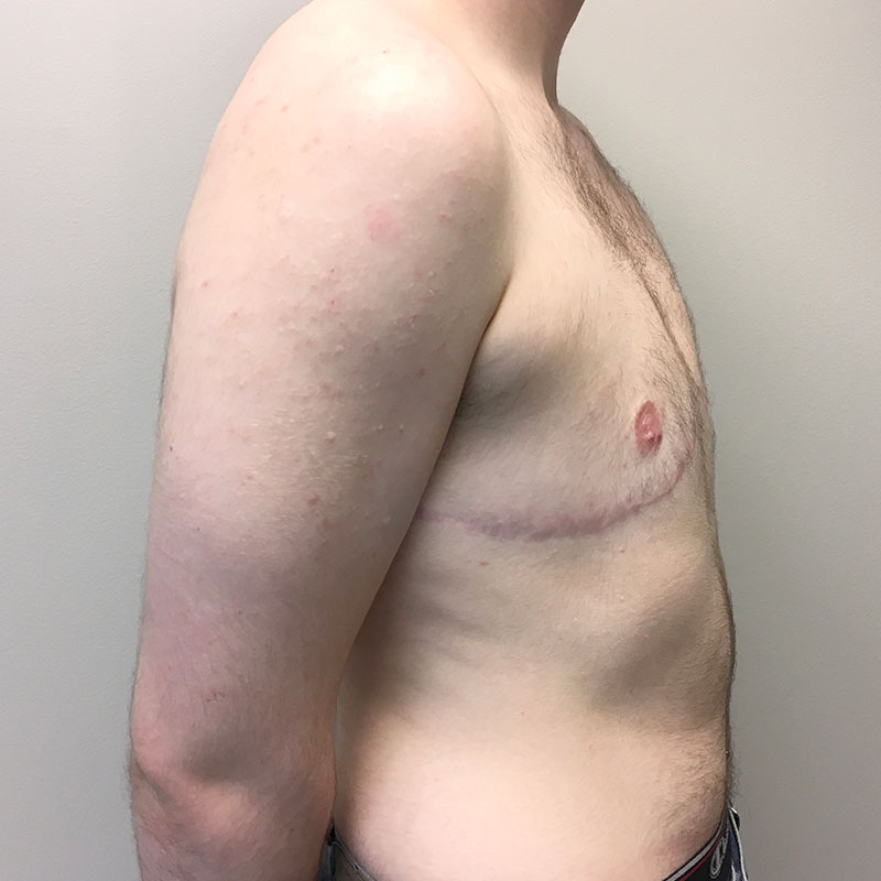 Female To Male Top Surgery 09