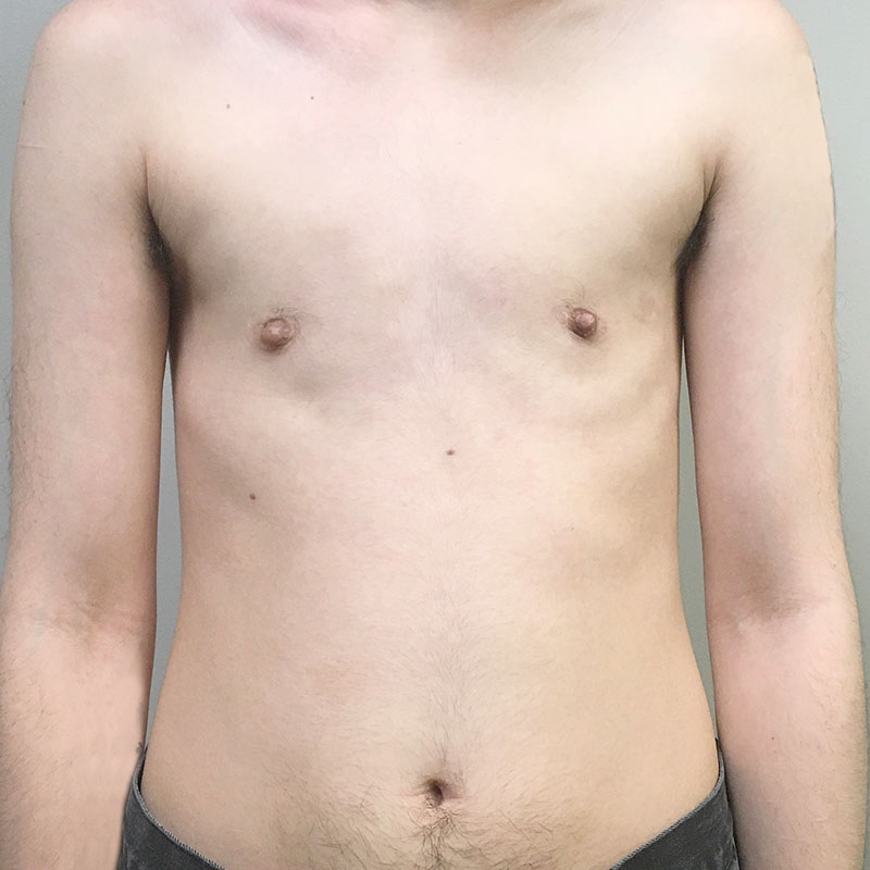 Female To Male Top Surgery 57