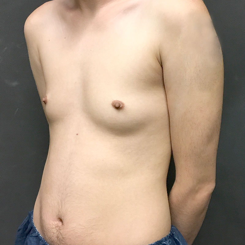 Female To Male Top Surgery 03