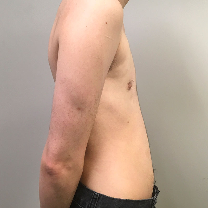 Female To Male Top Surgery 09