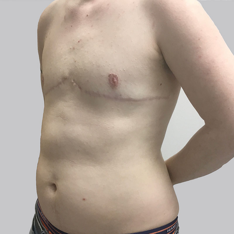 Female To Male Top Surgery 03