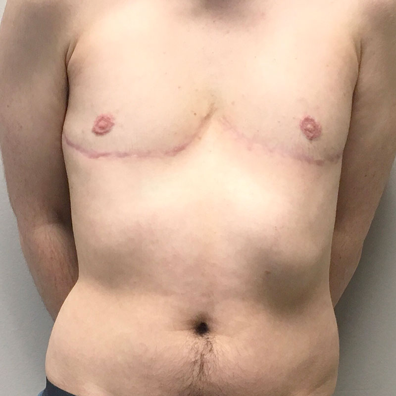 Female To Male Top Surgery 59