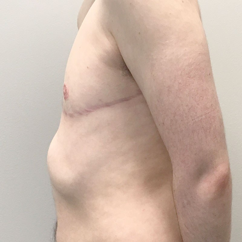 Female To Male Top Surgery 03