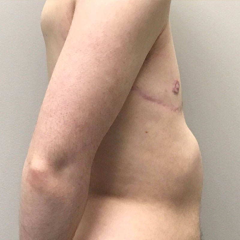 Female To Male Top Surgery 05