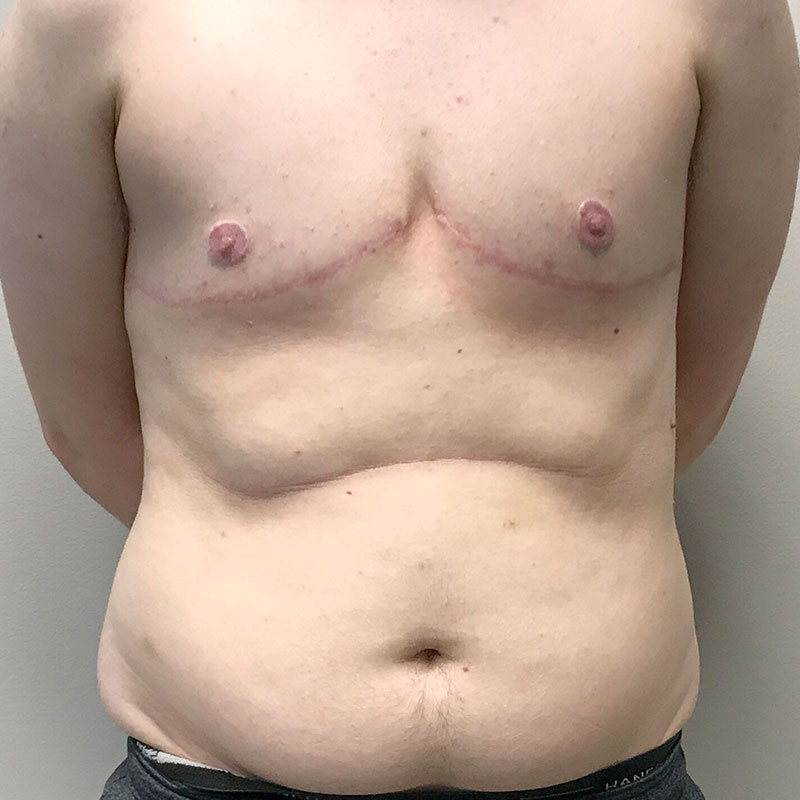 Female To Male Top Surgery 60