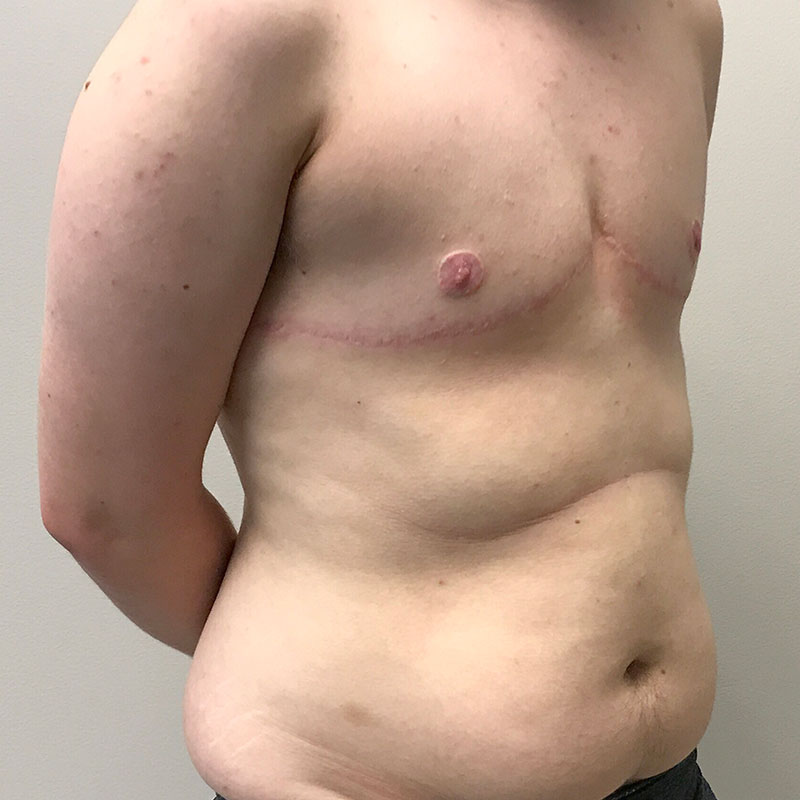 Female To Male Top Surgery 07