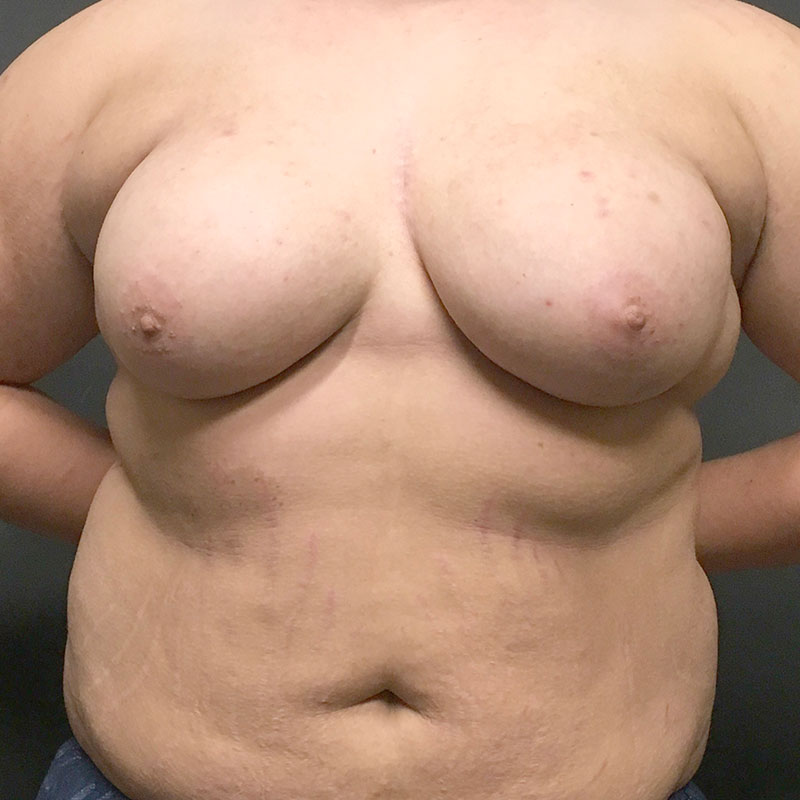 Female To Male Top Surgery 01