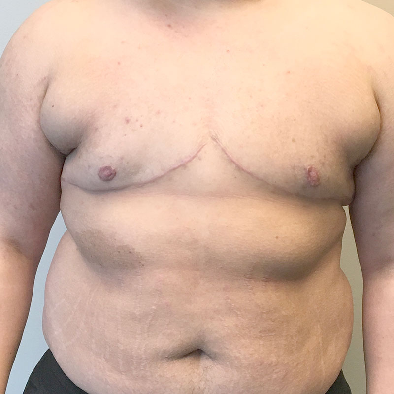 Female To Male Top Surgery 61