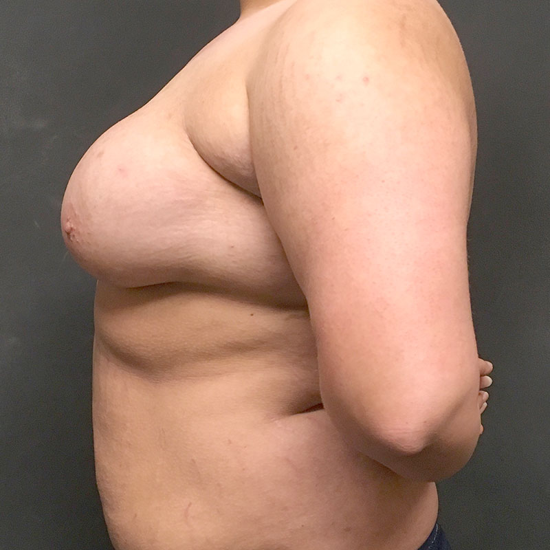 Female To Male Top Surgery 03