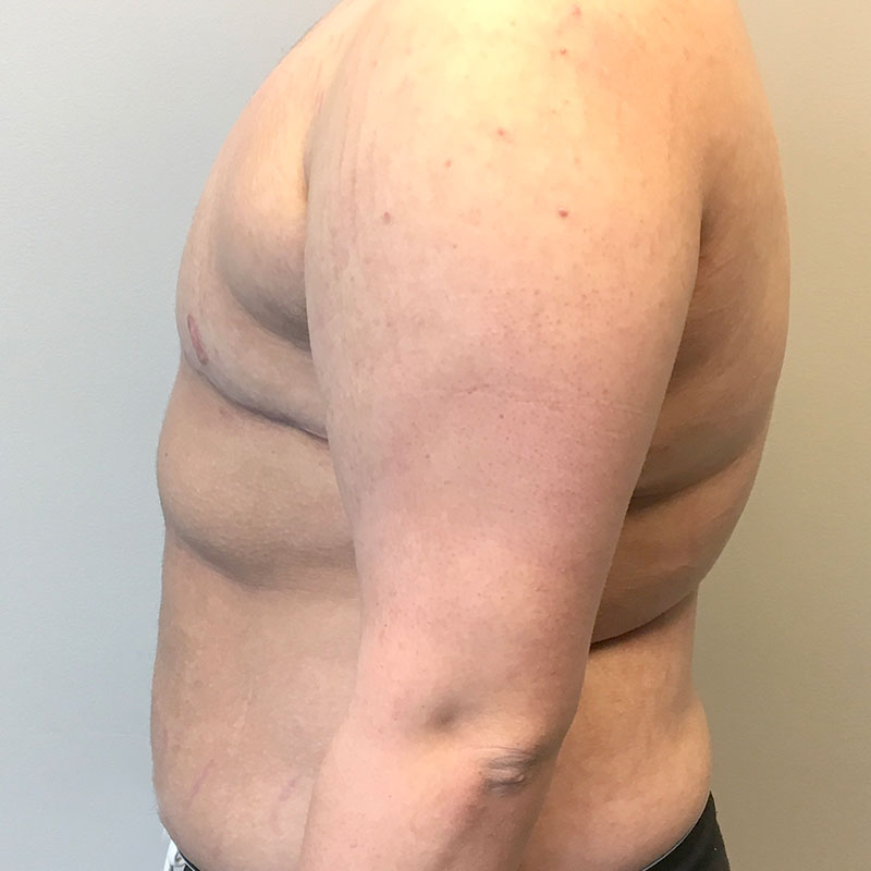 Female To Male Top Surgery 03