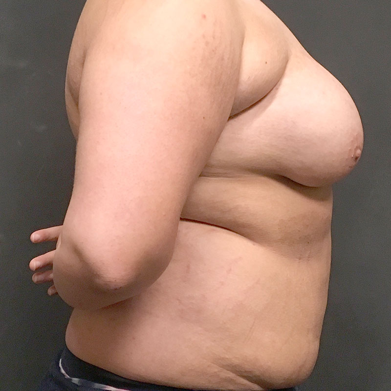 Female To Male Top Surgery 05