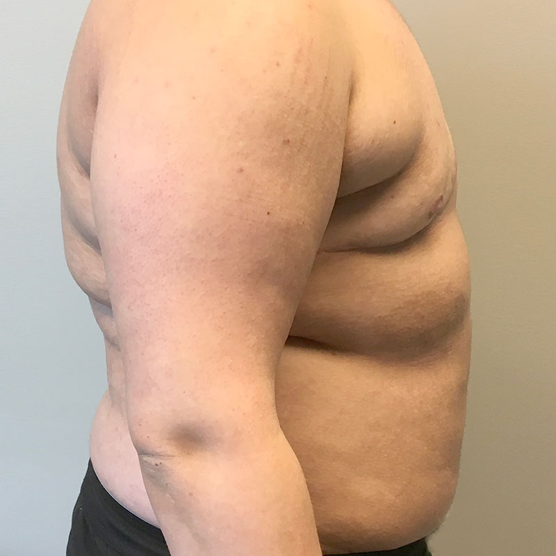 Female To Male Top Surgery 05