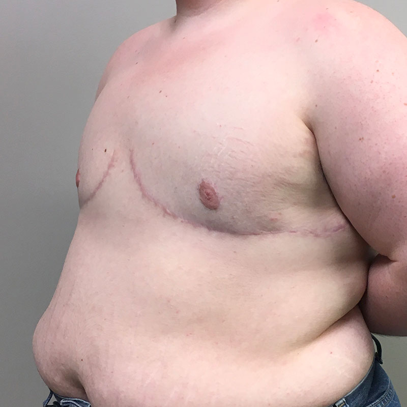 Female To Male Top Surgery 03