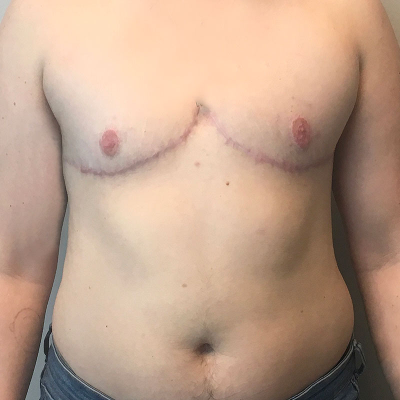 Female To Male Top Surgery 63