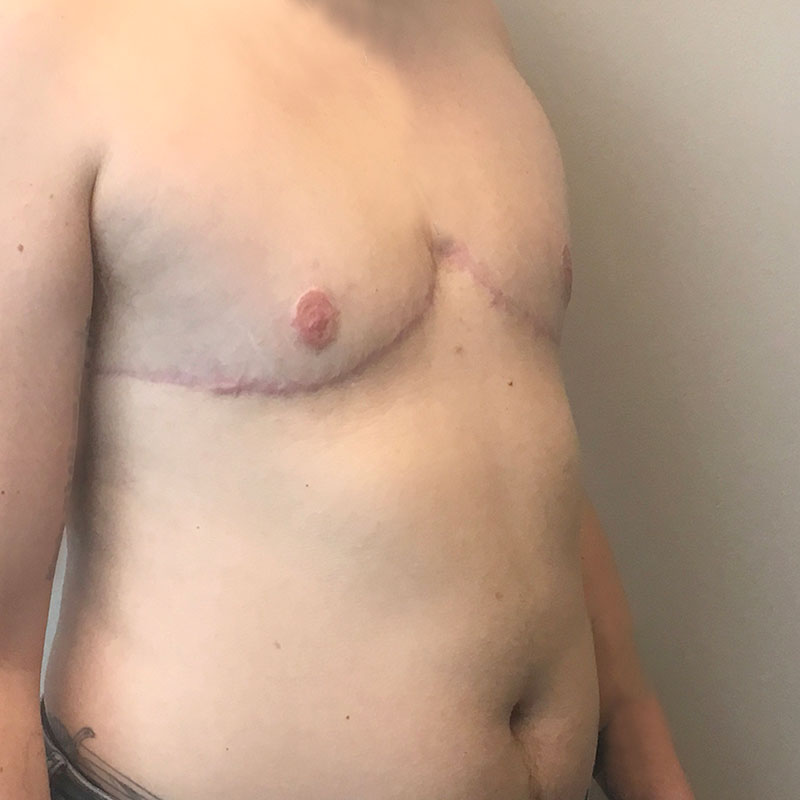 Female To Male Top Surgery 07