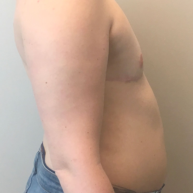 Female To Male Top Surgery 09