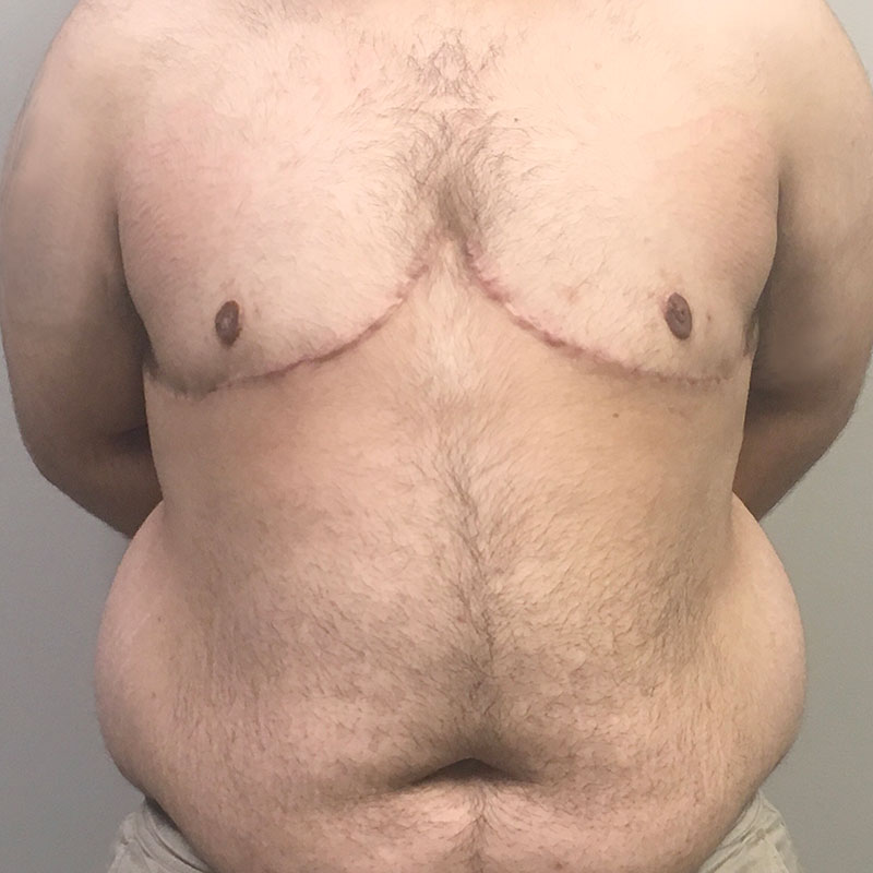 Female To Male Top Surgery 64