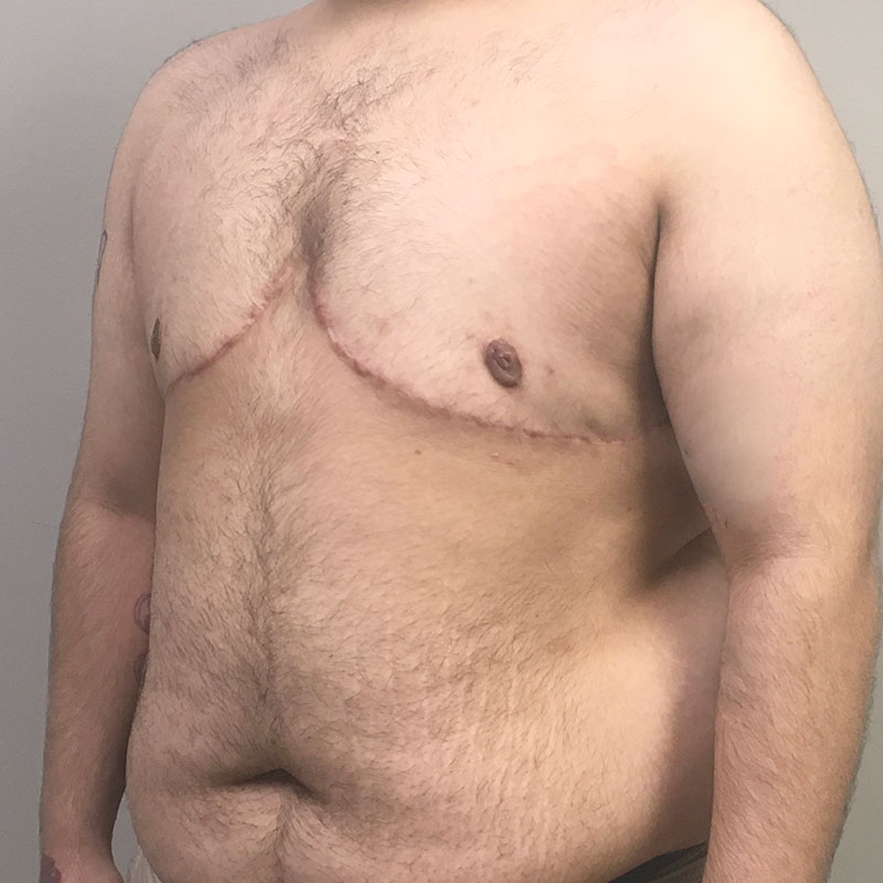 Female To Male Top Surgery 03