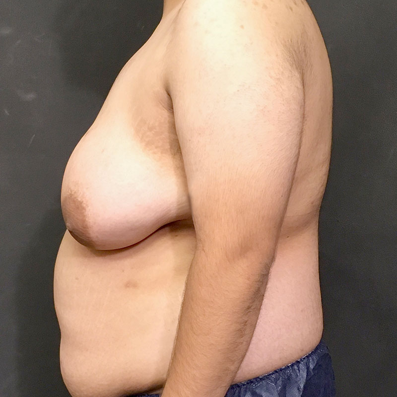 Female To Male Top Surgery 05