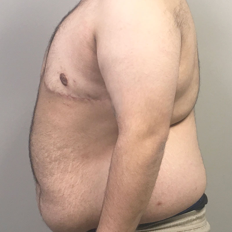 Female To Male Top Surgery 05