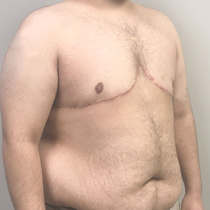 Female To Male Top Surgery 07