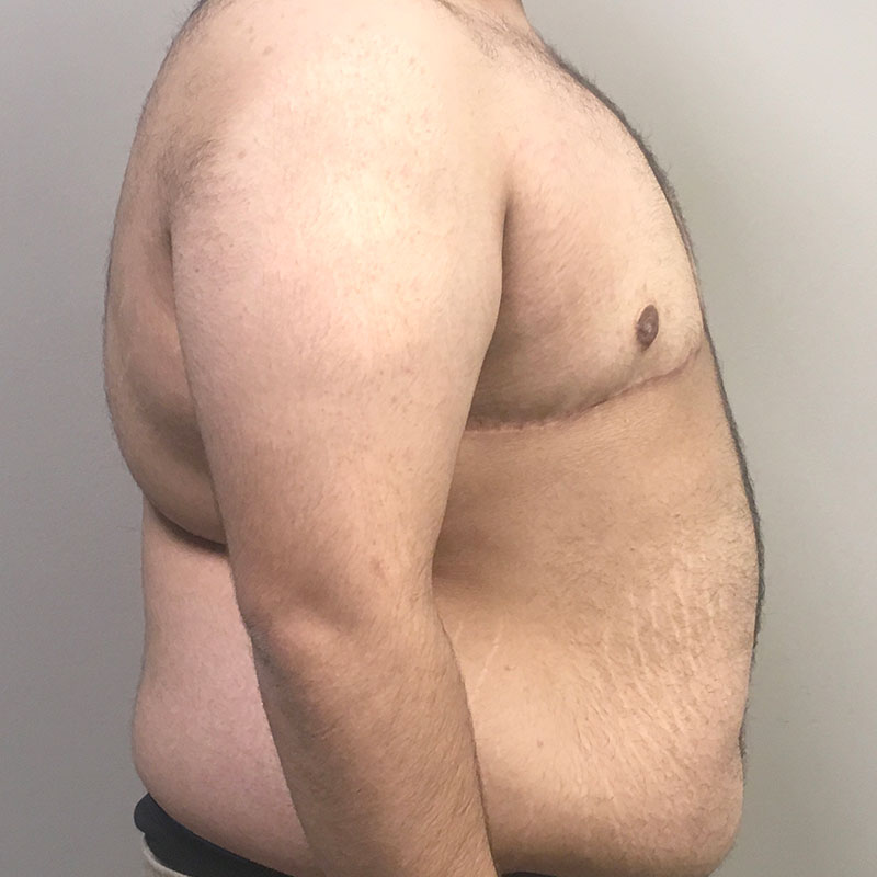 Female To Male Top Surgery 09