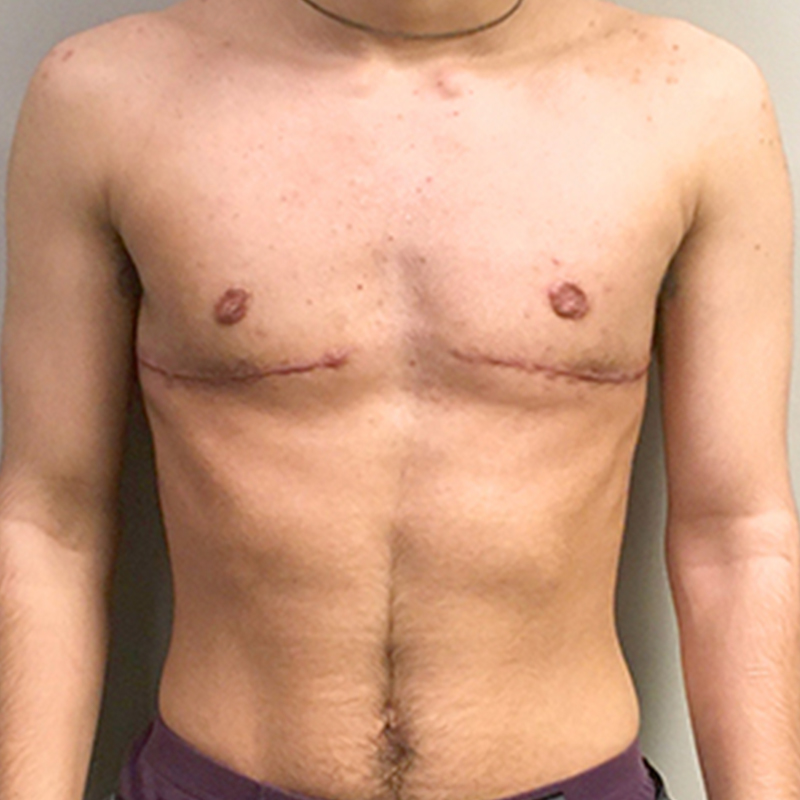 Female To Male Top Surgery 65