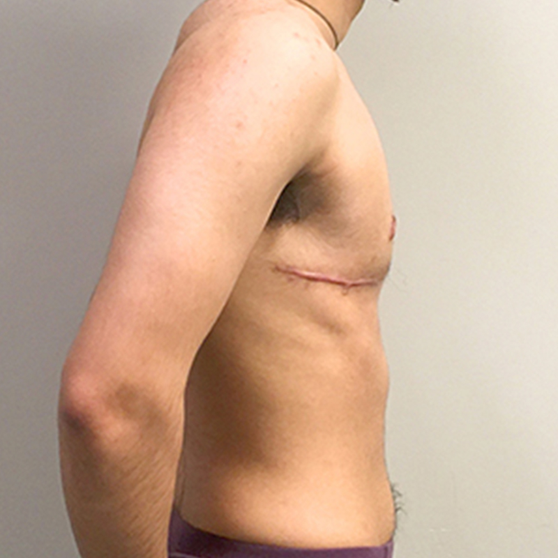 Female To Male Top Surgery 07