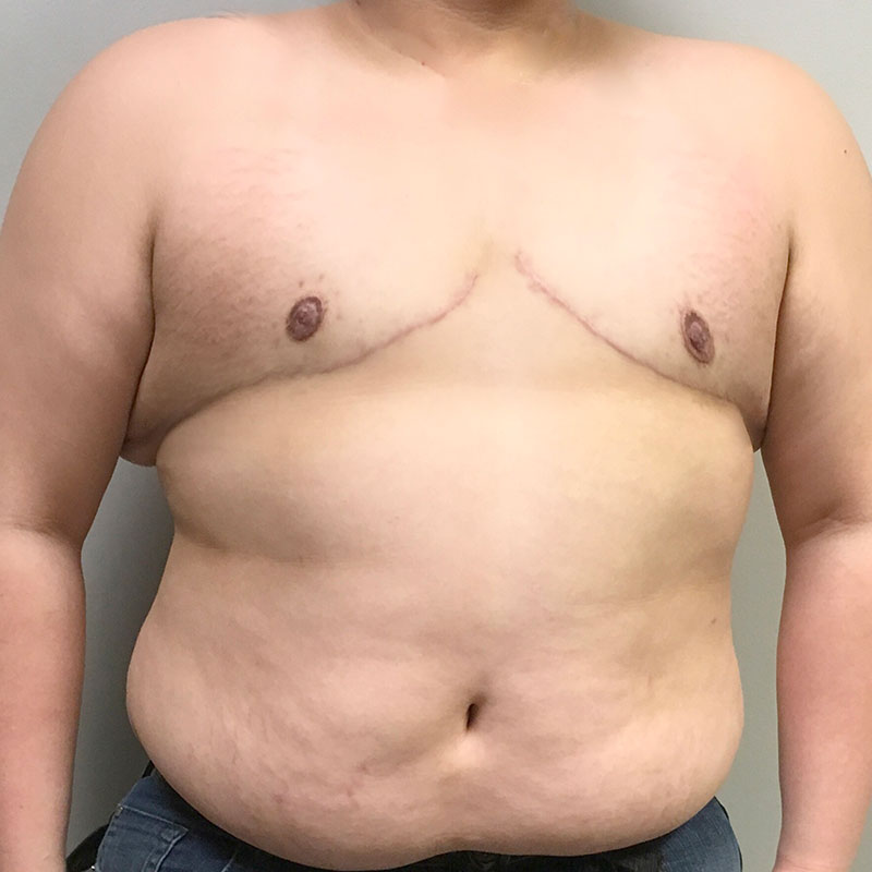 Female To Male Top Surgery 66