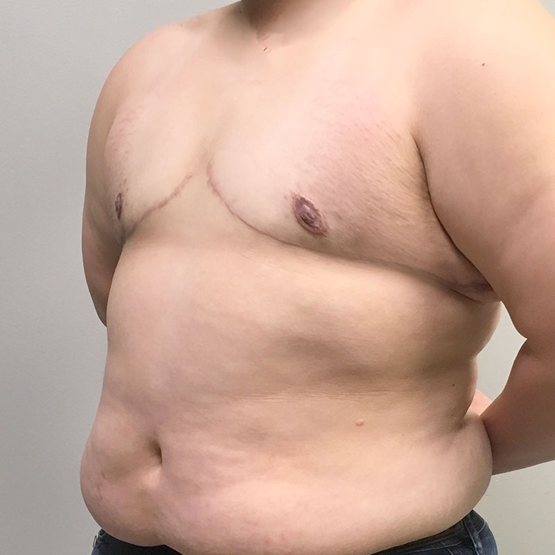 Female To Male Top Surgery 03