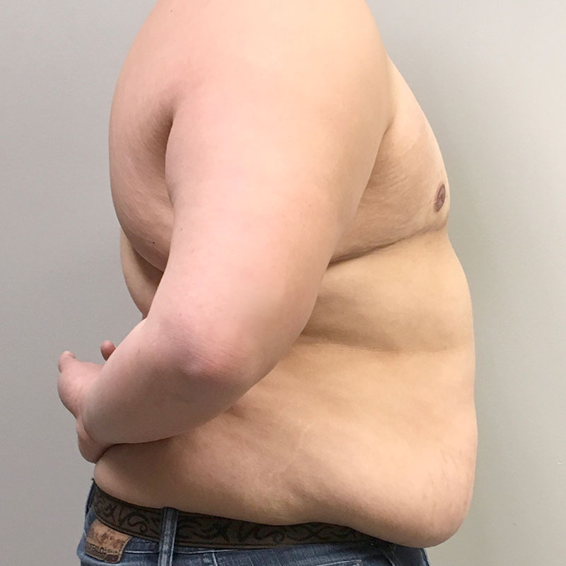 Female To Male Top Surgery 09