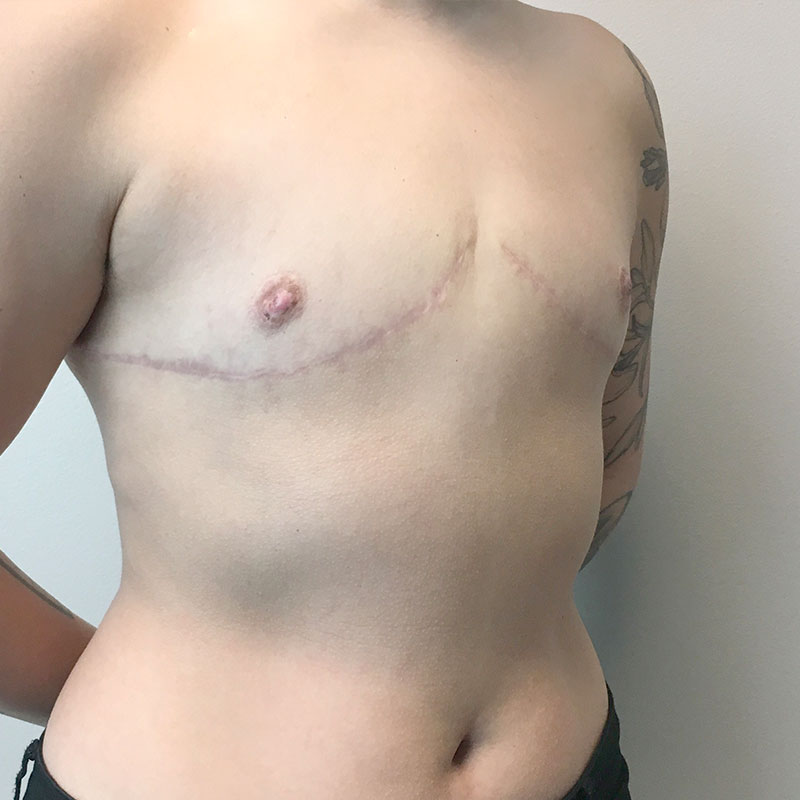 Female To Male Top Surgery 07