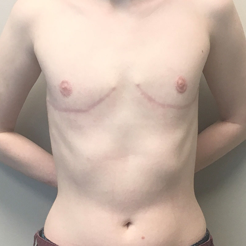 Female To Male Top Surgery 68