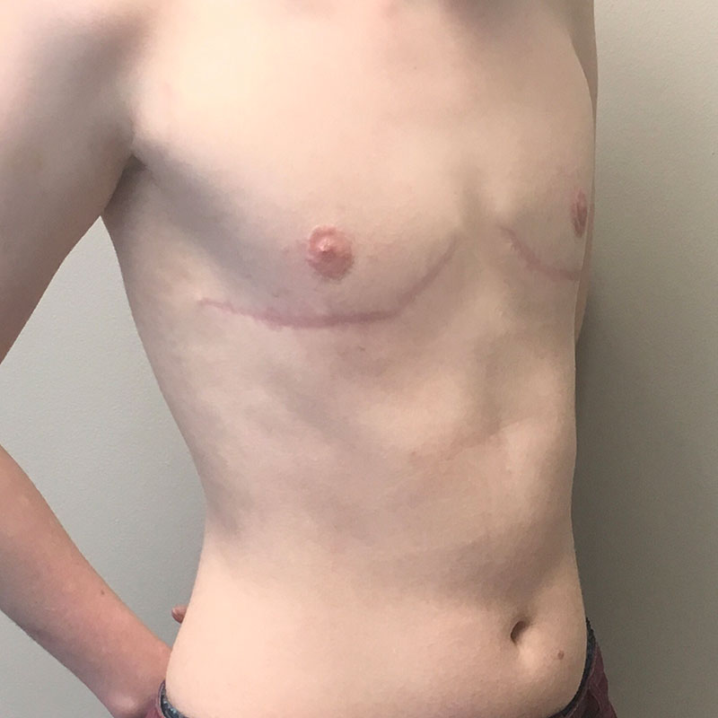 Female To Male Top Surgery 07