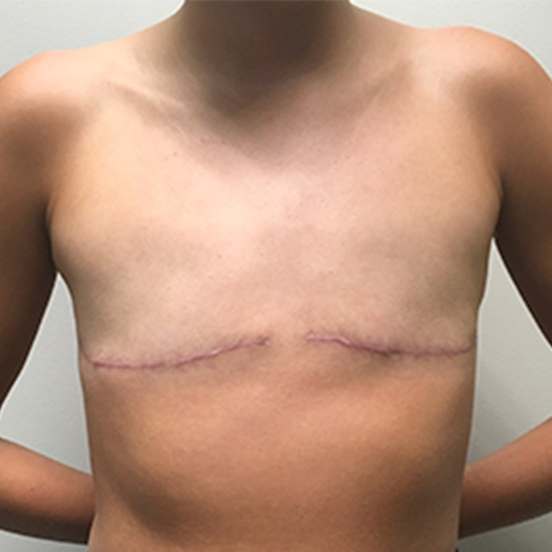 Female To Male Top Surgery 69