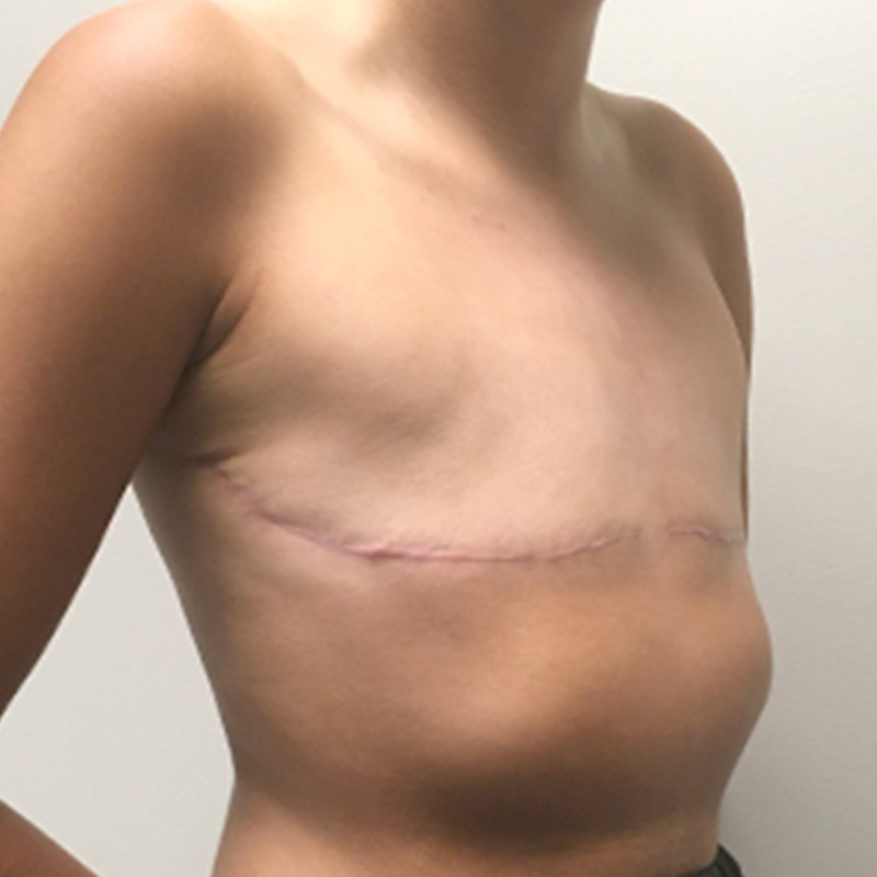 Female To Male Top Surgery 03