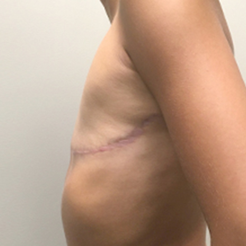 Female To Male Top Surgery 07