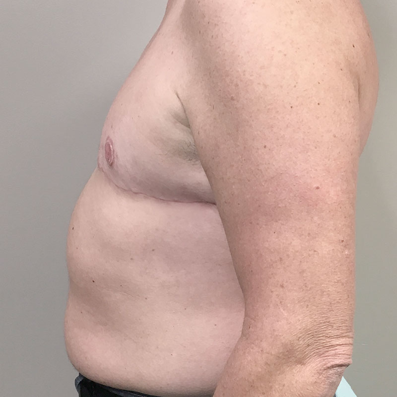 Female To Male Top Surgery 03