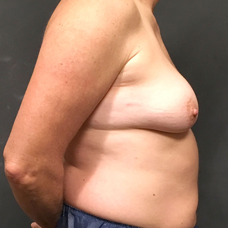 Female To Male Top Surgery 05