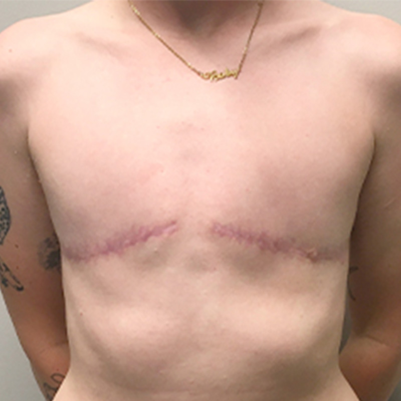 Female To Male Top Surgery 71