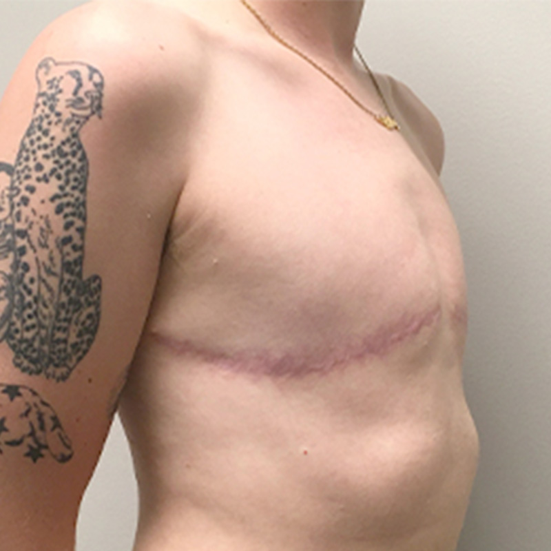 Female To Male Top Surgery 03