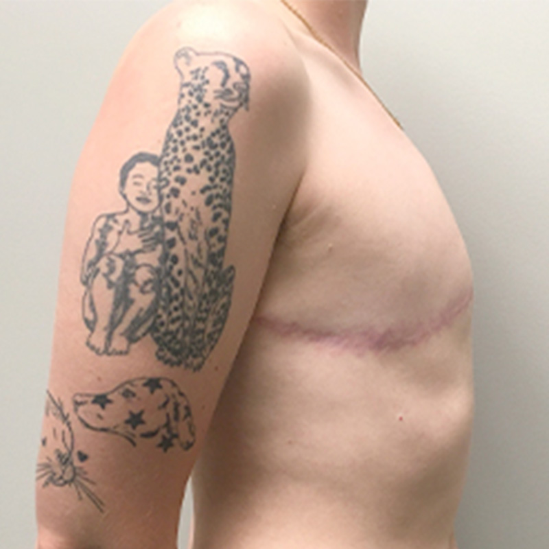 Female To Male Top Surgery 05