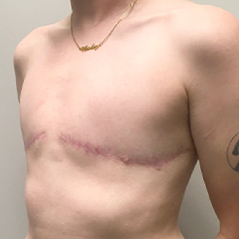 Female To Male Top Surgery 07