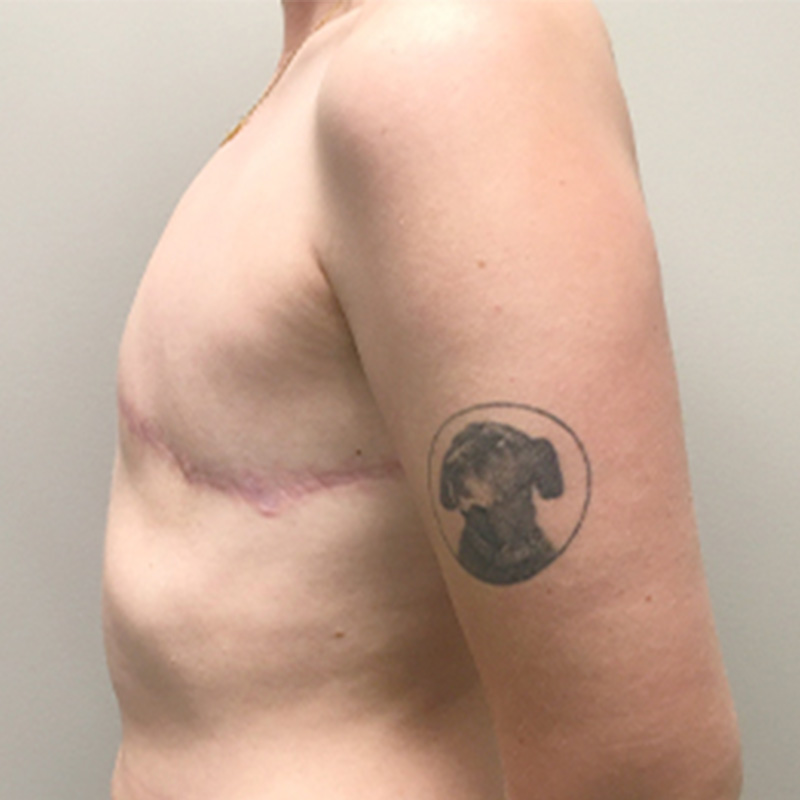 Female To Male Top Surgery 09