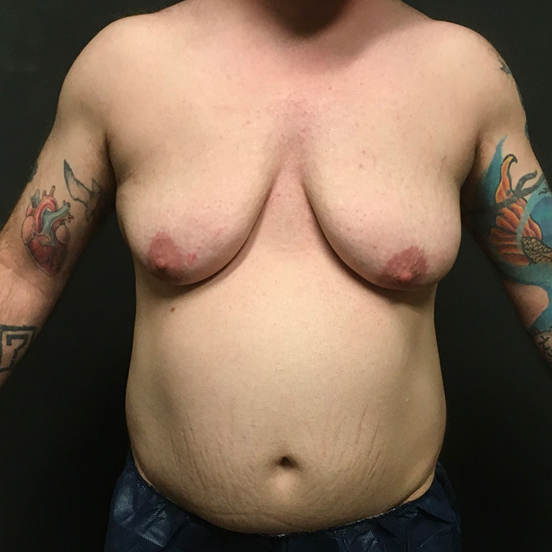 Female To Male Top Surgery 01