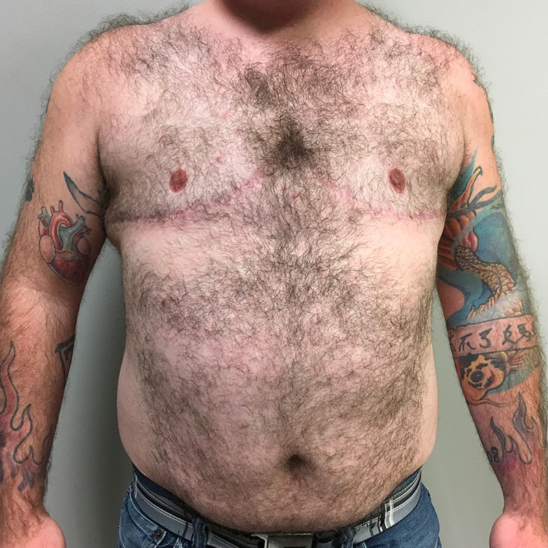 Female To Male Top Surgery 72