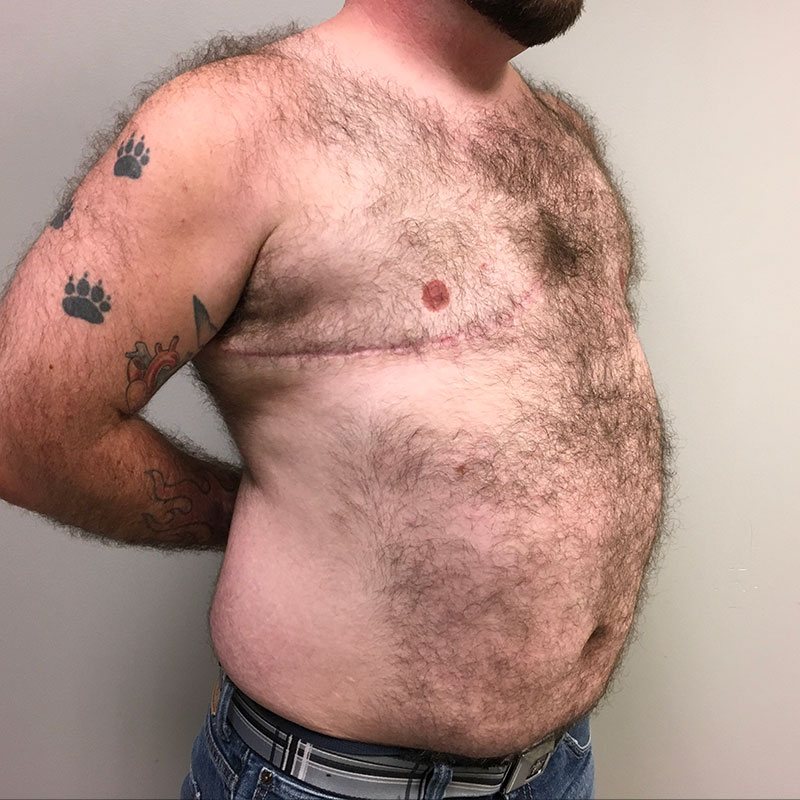 Female To Male Top Surgery 05