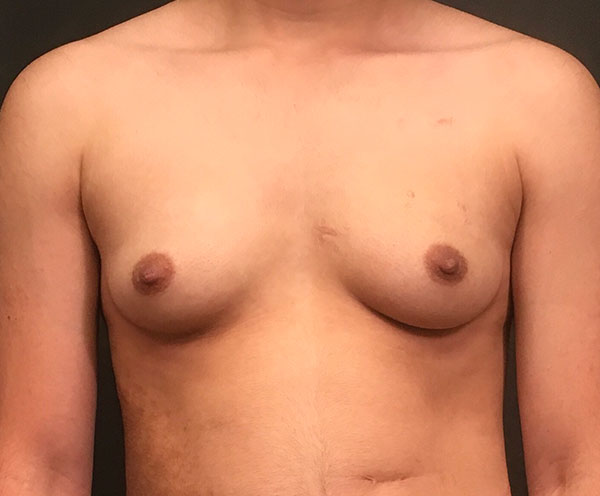 Female To Male Top Surgery 01